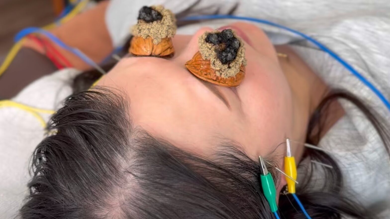 くるみ灸と電気鍼による施術の様子